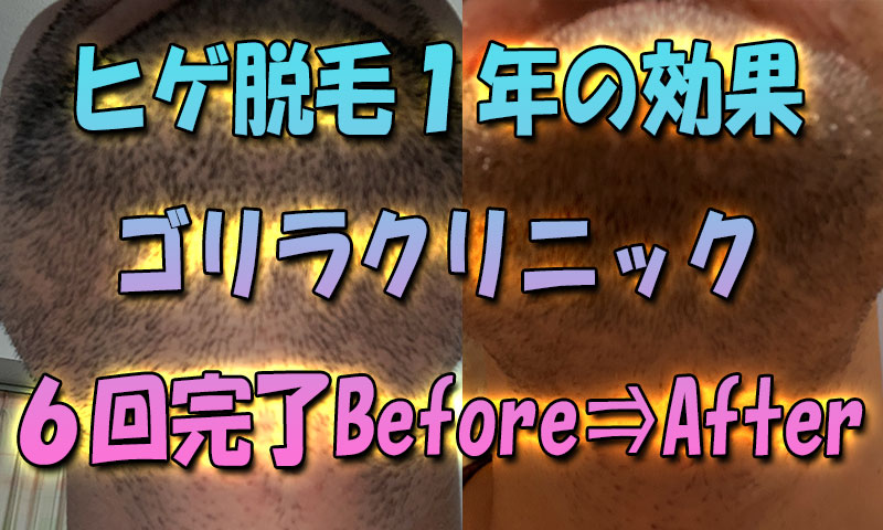 ヒゲレーザー脱毛1年の効果-ゴリラクリニック6回コース完了のBefore⇒After(写真比較)