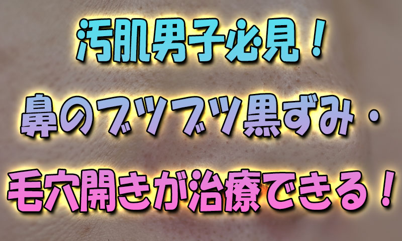 汚肌男子必見！鼻のブツブツの黒ずみ・毛穴開きが治療できる！？試してみた結果